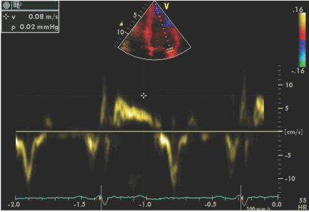 Hình ảnh Doppler mô