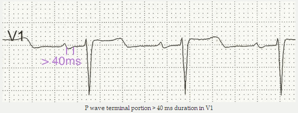 Sóng P với thời gian phần cuối > 40 ms trong V1