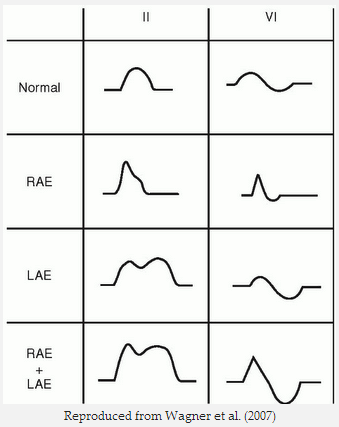 Sóng P phổ biến trong đạo trình DII và V1 với phì đại tâm nhĩ phải, trái và hai tâm nhĩ