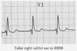 Tai thỏ phải cao hơn trong RBBB