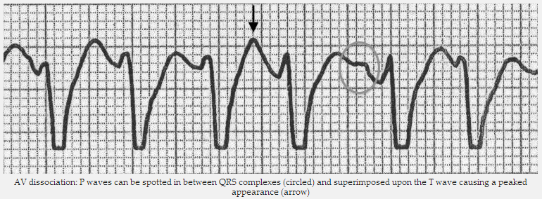 Phân ly AV: sóng P có thể được phát hiện ở giữa phức bộ QRS (vòng tròn) và chồng trên sóng T, gây ra một sự xuất hiện đỉnh (mũi tên).