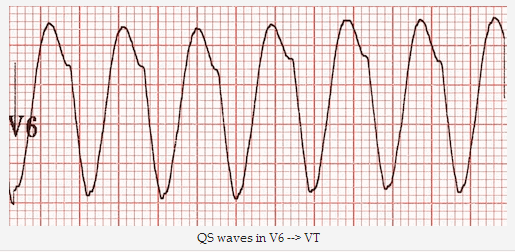 Sóng QS trong V6 => VT