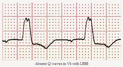 Sóng Q vắng mặt trong V6 với LBBB