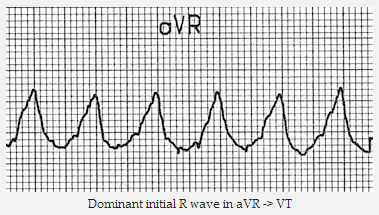 Ưu thế đầu sóng R trong aVR => VT