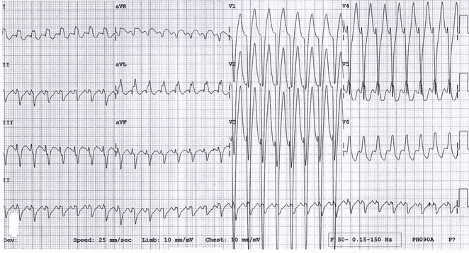 Nhịp tim nhanh phức bộ rộng do AVRT antidromic trong một cậu bé 15 tuổi