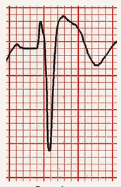 Dấu hiệu Brugada