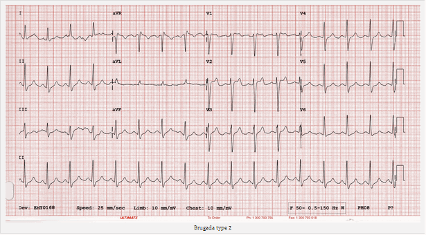Brugada type 2