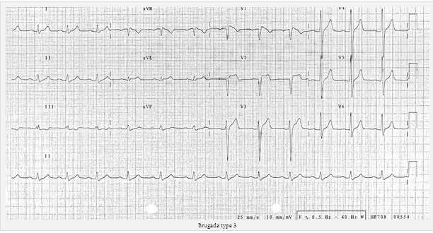 Brugada type 3 
