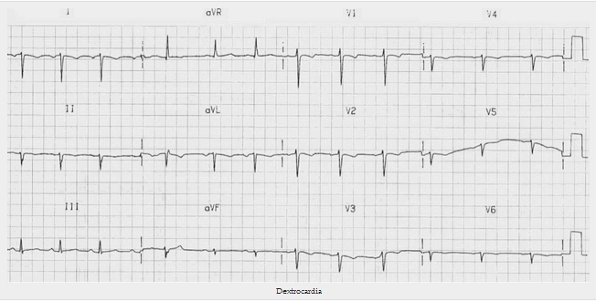 Dextrocardia