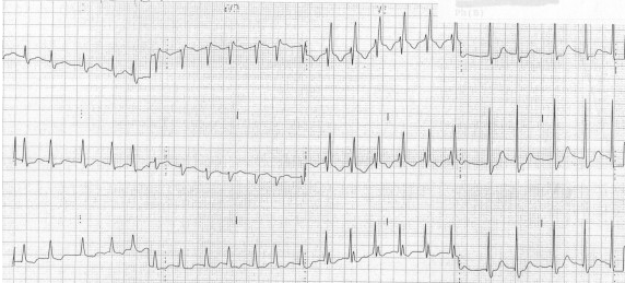 Sóng T đảo ngược trong các đạo trình trước tim bên phải do RBBB