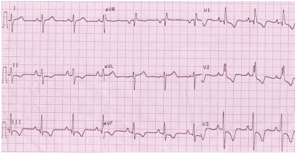 Đảo ngược sóng T trong đạo trình trước tim vùng dưới và bên phải do RVH