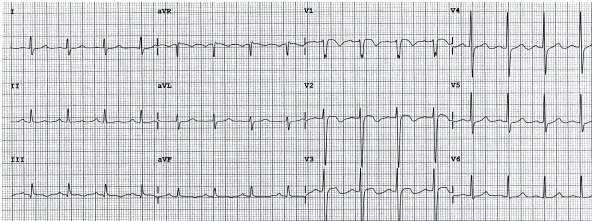 Đảo ngược sóng T trong các đạo trình trước tim vùng dưới và phải ở bệnh nhân với kích thích điện được lập trình (PES) hai bên