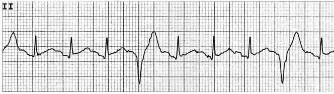 Nhịp tim nhanh xoang với PVC thường xuyên trong hình ngoại tâm thu thất nhịp bốn