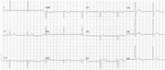 Sóng U ngược ở bệnh nhân với nhồi máu cơ tim không ST chênh lên (NSTEMI)