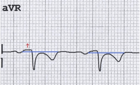Đoạn PR cao trong aVR do viêm màng ngoài tim cấp tính (chú ý đoạn ST giảm xuống đối ứng)