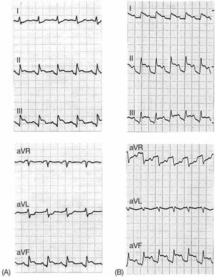 Đoạn PR giảm xuống trong chuyển đạo thành dưới với (A) và không với (B) đoạn TP rõ ràng trong nhồi máu cơ tim cấp tính vùng thành dưới. Lưu ý ST cũng chênh cao trong chuyển đạo thành dưới