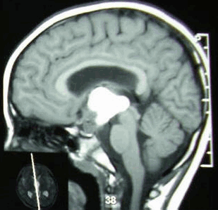 Hình ảnh cắt qua mặt phẳng dọc giữa trên MRI.