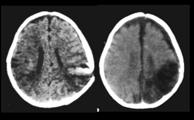 Hình ảnh nhuyễn não và teo não vùng chẩm (T) sau dập xuất huyết não 3 tháng trước
