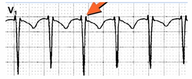 Cấu hình R’ giả của chuyển đạo V1 trong nhịp tim nhanh do vòng vào lại nút nhĩ thất. Mũi tên là sóng P trong phần cuối của phức hợp QRS.