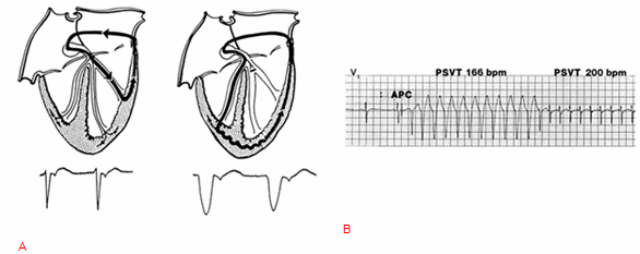Nhịp tim nhanh vào lại nhĩ thất (AVRT) với đường phụ bên trái và dẫn truyền bình thường qua nhánh trái (bên trái)