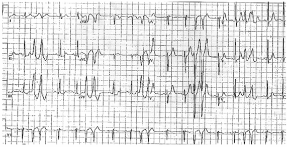 Nhịp tim nhanh thất bó đường ra thất phải (block nhánh trái - biến đổi trục lệch phải).