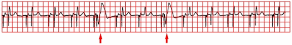 Điện tâm đồ thể hiện tạo nhịp tim an toàn