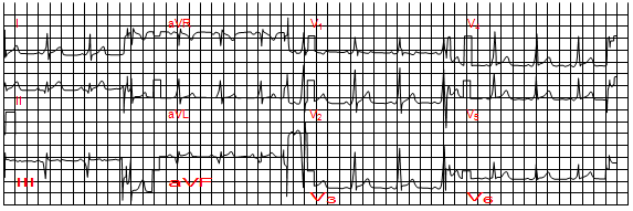 Giả nhồi máu cơ tim vùng sau dưới do hội chứng Wolff-Parkinson-White trên hình ảnh điện tâm đồ