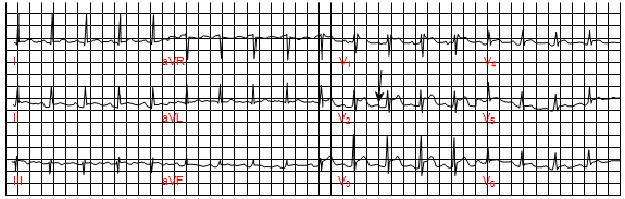 Viêm màng ngoài tim cấp tính với đoạn PR thấp xuống (mũi tên)