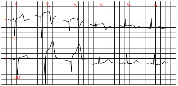 Khu vực viêm màng ngoài tim sau nhồi máu cơ tim cấp tính. b, nhồi máu cấp tính; f, độ cao liên tục ST V2-V4.