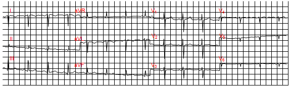 Dextrocardia (tim lệch phải hoặc đảo ngược vị trí)