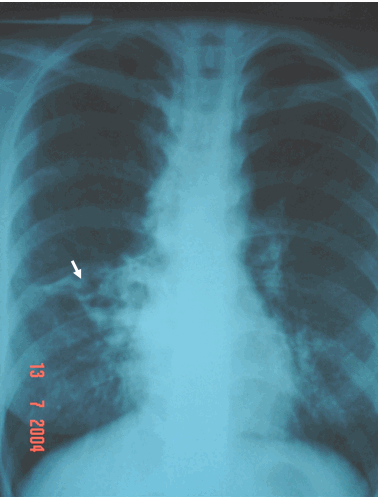 Hình ảnh giãn phế quản phổi phải trên phim phổi chuẩn