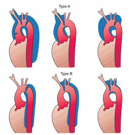 Phân loại bóc tách động mạch chủ