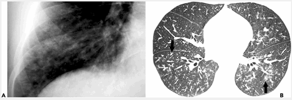 Viêm tiểu phế quản cấp tính do Mycoplasma pneumoniae