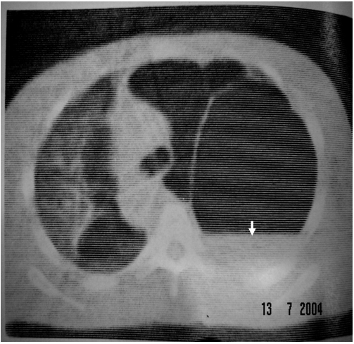 Hình ảnh kén hơi khổng lồ bên phổi trái với bờ rất mỏng (mũi tên phía trên) bị bội nhiễm có mức nước mức hơi (mũi tên phí dưới) trên phim chụp phổi cắt lớp vi tính