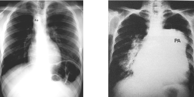 Bóng tim bình thường (trái), bóng tim lớn từng buồng (phải)