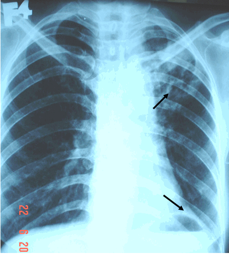 Hình ảnh lao thuỳ trên phổi trái