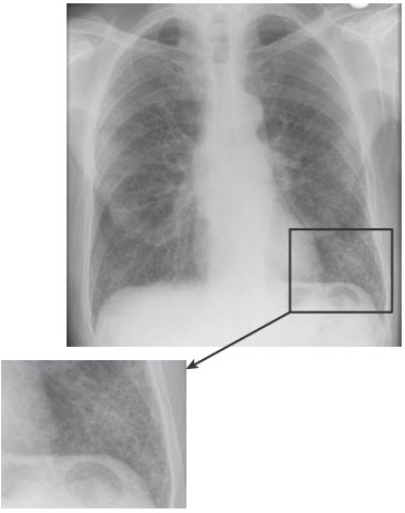 X quang ngực trong bệnh phổi kẽ