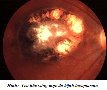 Mắt do bệnh toxoplasma
