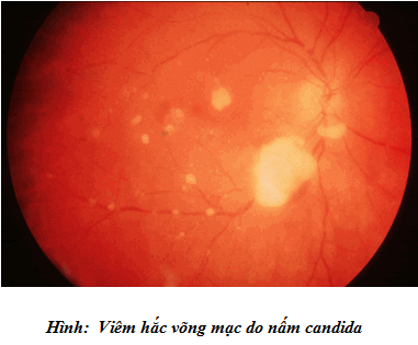 Viêm mắt do nấm Candida 