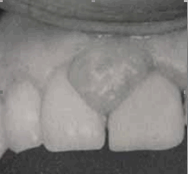 Vệ sinh răng miệng tốt trong thời kỳ thai nghén