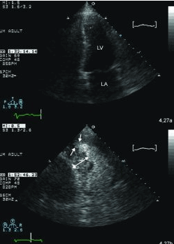 Hình ảnh hai buồng tim từ đỉnh ghi nhận ở bệnh nhân bị loạn nhịp thất