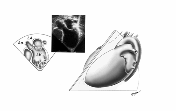 Mặt cắt 3 buồng tim từ mỏm. Tâm nhĩ trái (LA), tâm thất trái (LV) và đường ra, động mạch chủ (Ao).