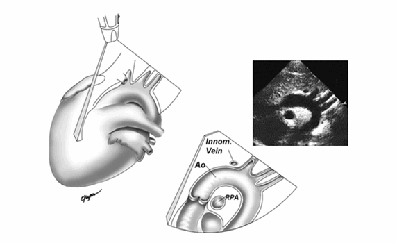 Mặt cắt trên hõm ức trục dài dọc động mạch chủ (Ao).