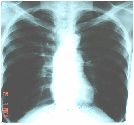 Hình ảnh tâm phế mạn - phổi giãn phế nang hai bên, tim thõng hình giọt nước, quai động mạch phổi phồng to