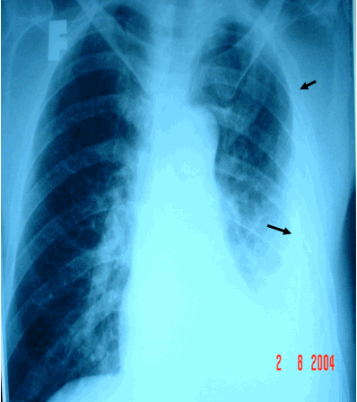 Tràn dịch màng phổi do lao