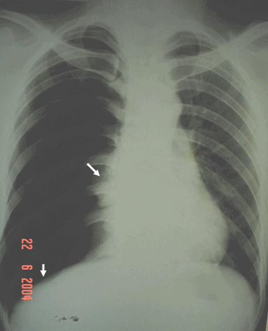 Hình ảnh tràn khí màng phổi toàn bộ bên phải