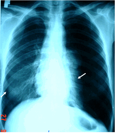 Hình ảnh tràn khí màng phổi hai bên