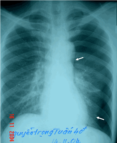 Hình ảnh tràn khí màng phổi trái (mũi tên dưới) & tràn khí trung thất (mũi tên trên) ở bệnh nhân nam, 40 tuổi
