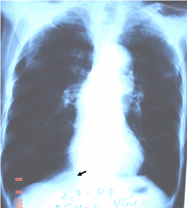 Kén hơi khổng lồ ở đáy phổi phải trên phim chụp thẳng - Hình chẩn đoán phân biệt với tràn khí màng phổi