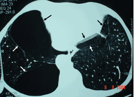 Hình ảnh các bóng khi khổng lồ chủ yếu bên phổi phảI - Hình chẩn đoán phân biệt với tràn khí màng phổi